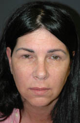 Mid Facelift - Patient 1 - Front - Before